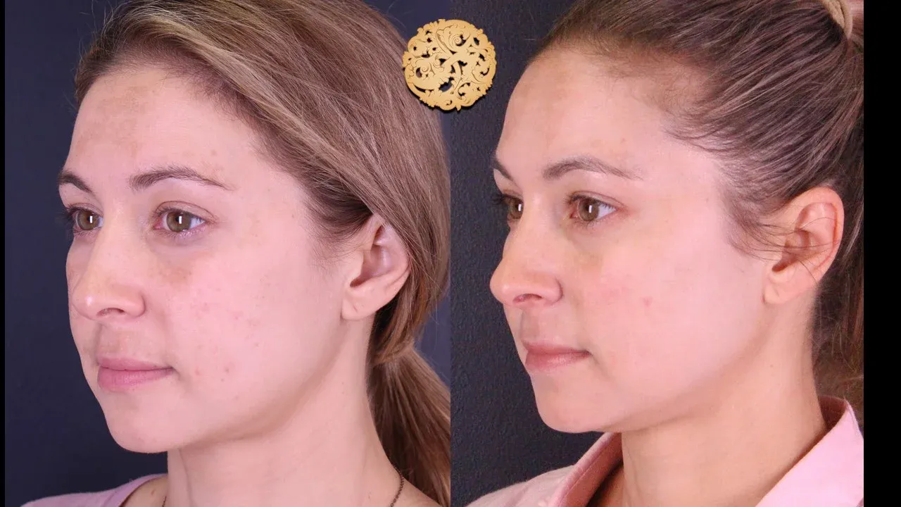 Microlaser Peel Before & After