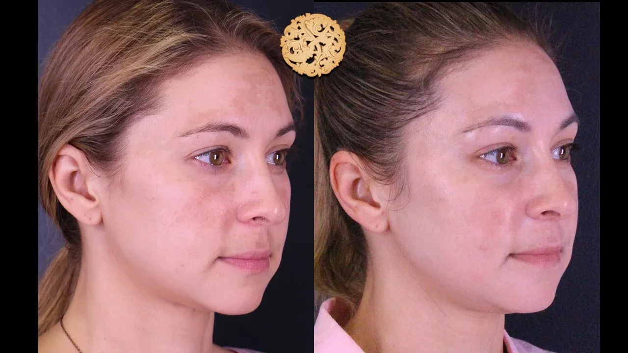 Microlaser Peel Before & After