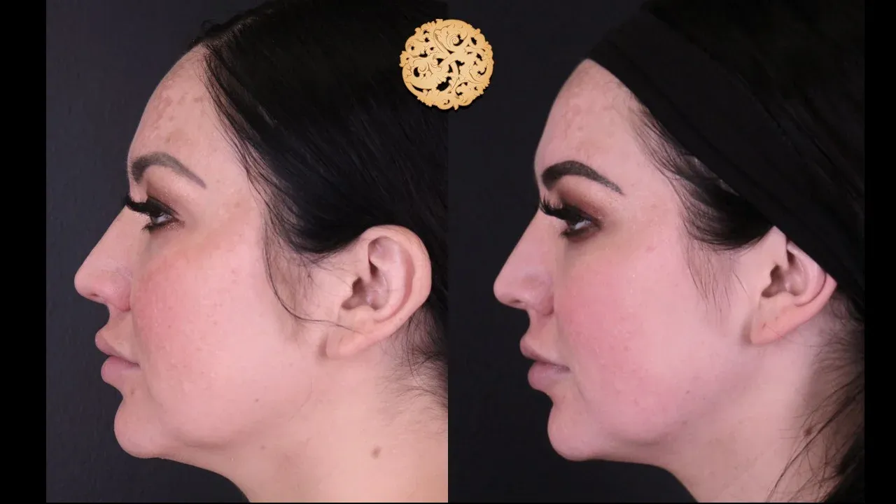 Microlaser Peel Before & After