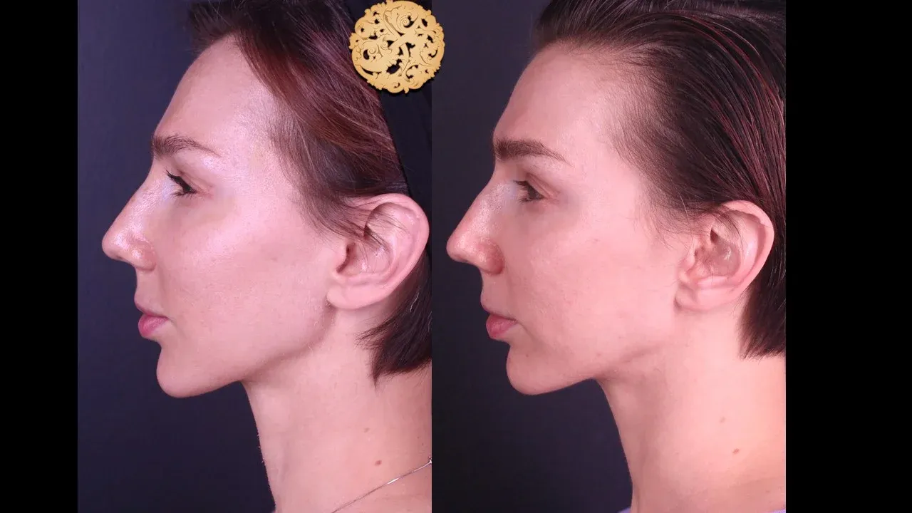 Microlaser Peel Before & After
