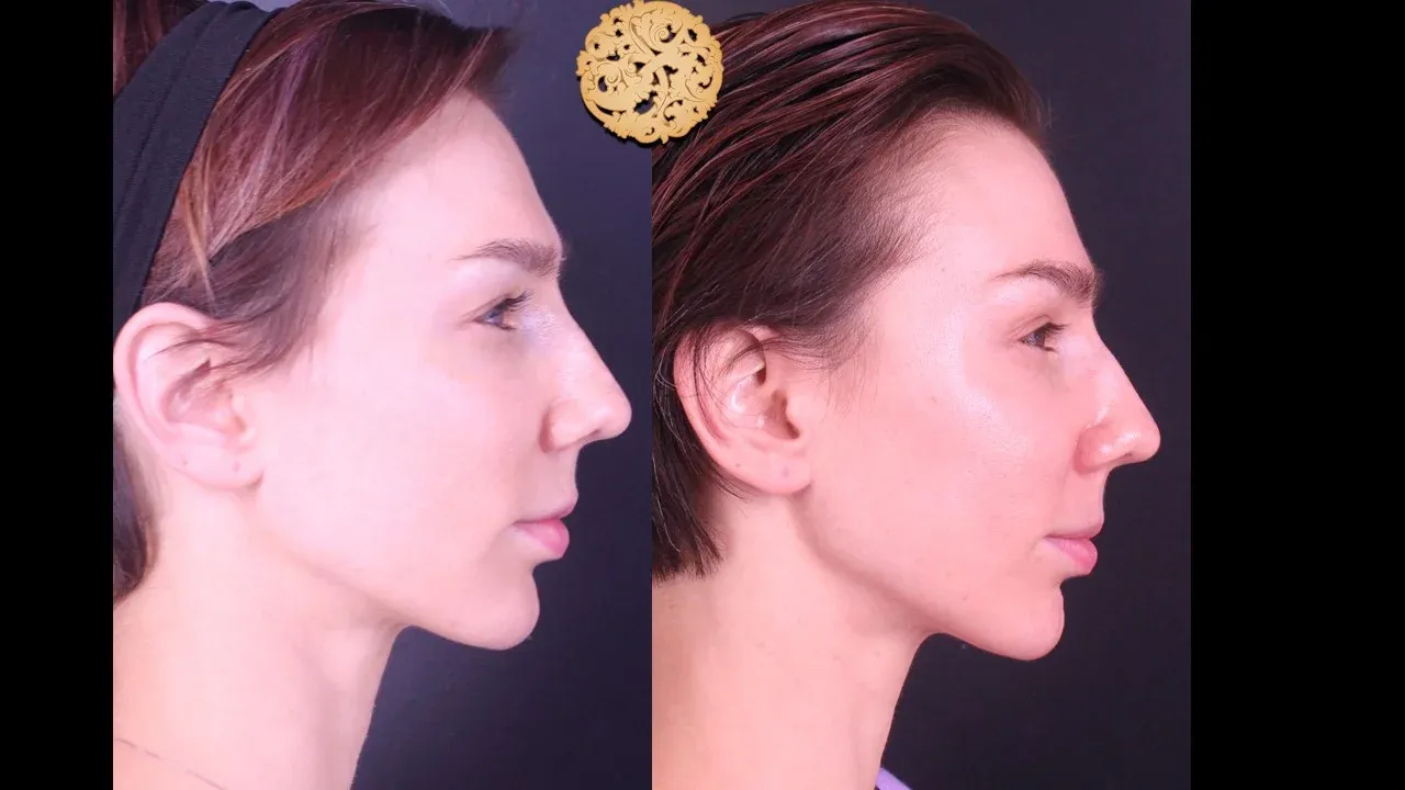 Microlaser Peel Before & After