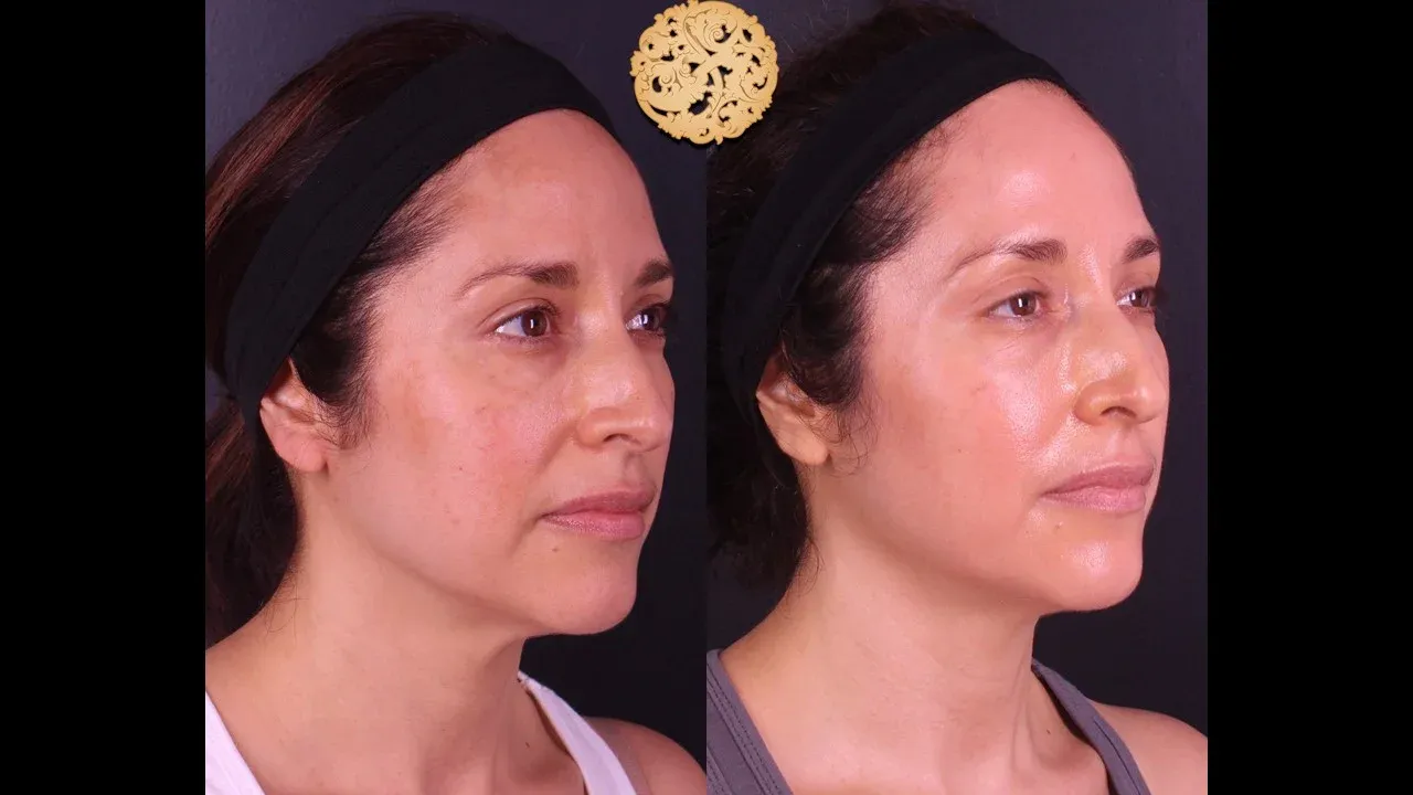 Microlaser Peel Before & After