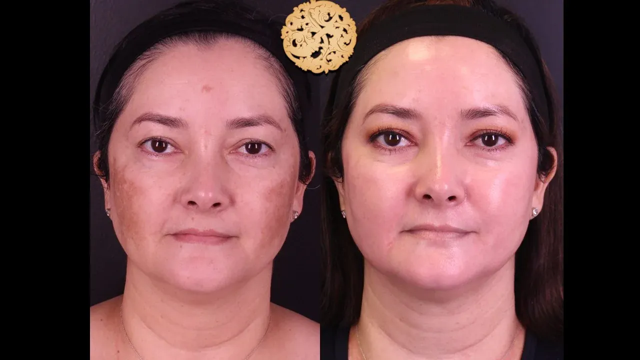 Microlaser Peel Before & After