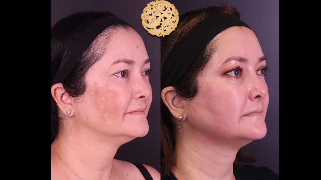 Microlaser Peel Before & After