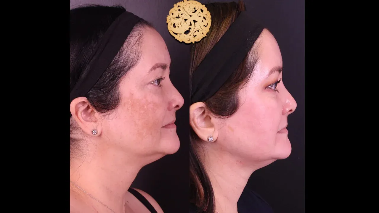 Microlaser Peel Before & After