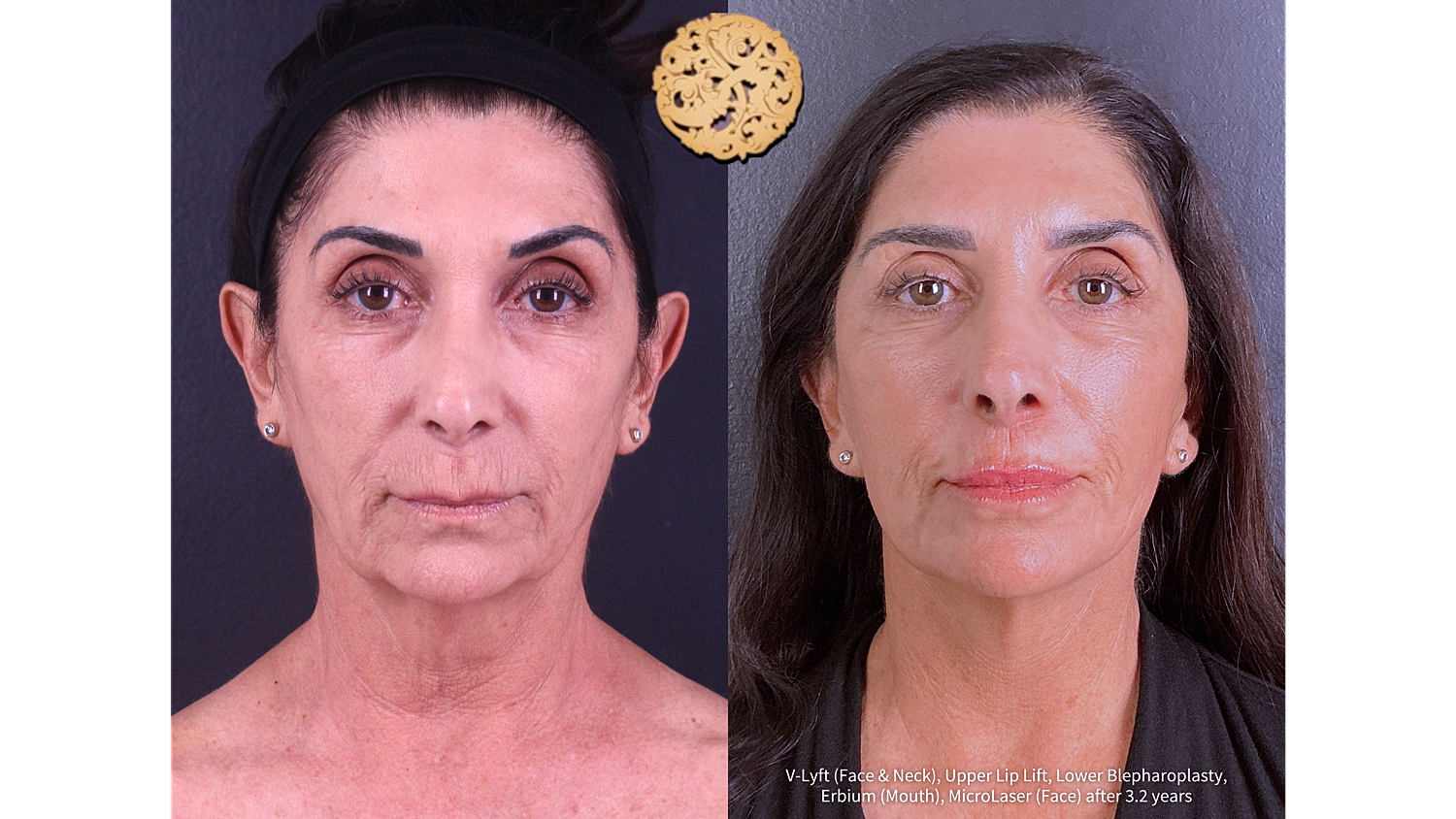 MicroLaser Peel Before and After