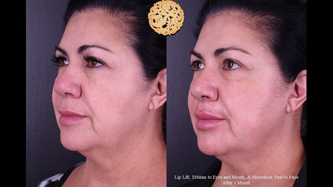 MicroLaser Peel Before & After