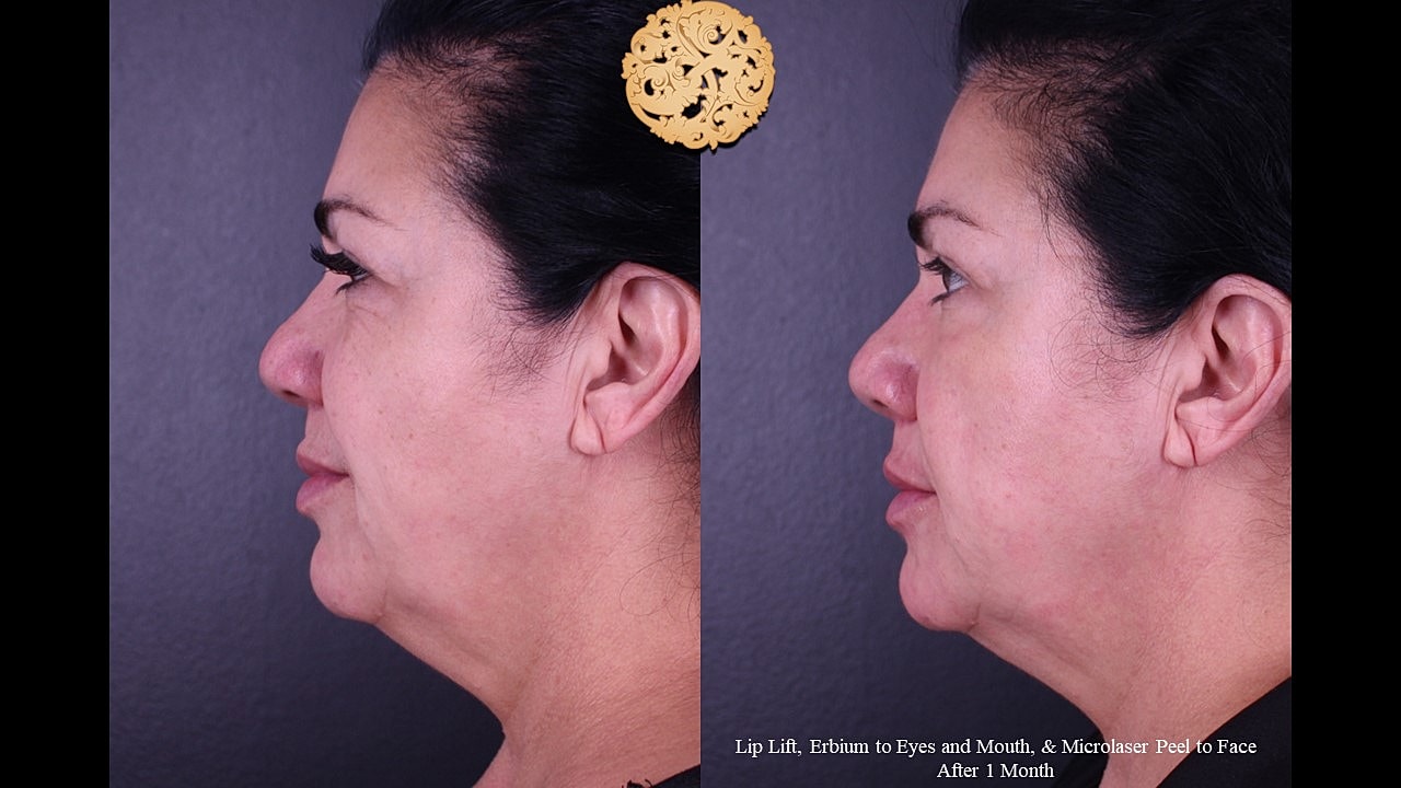 MicroLaser Peel Before & After