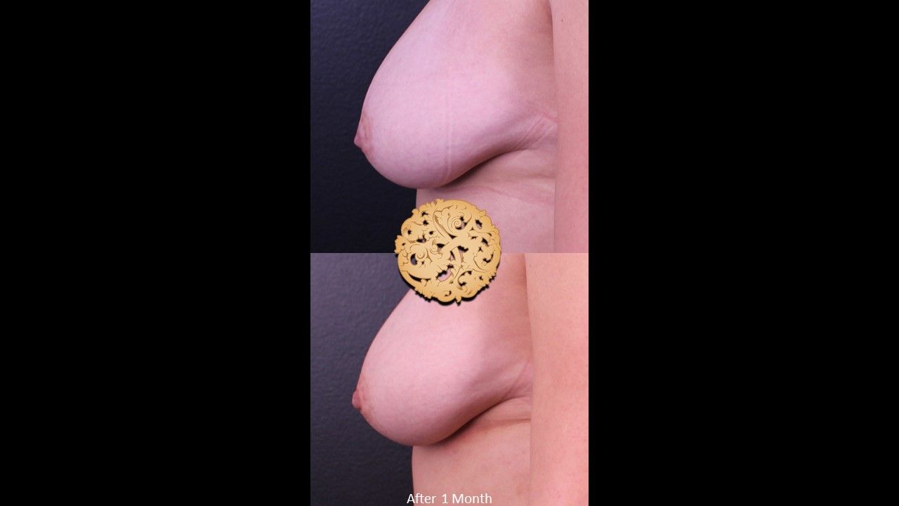 Inverted Nipple Repair Before & After