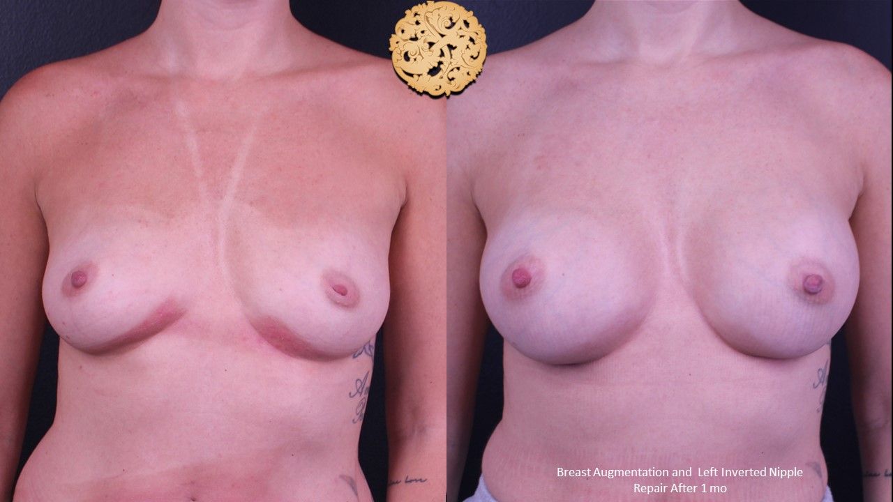 Inverted Nipple Repair Before & After
