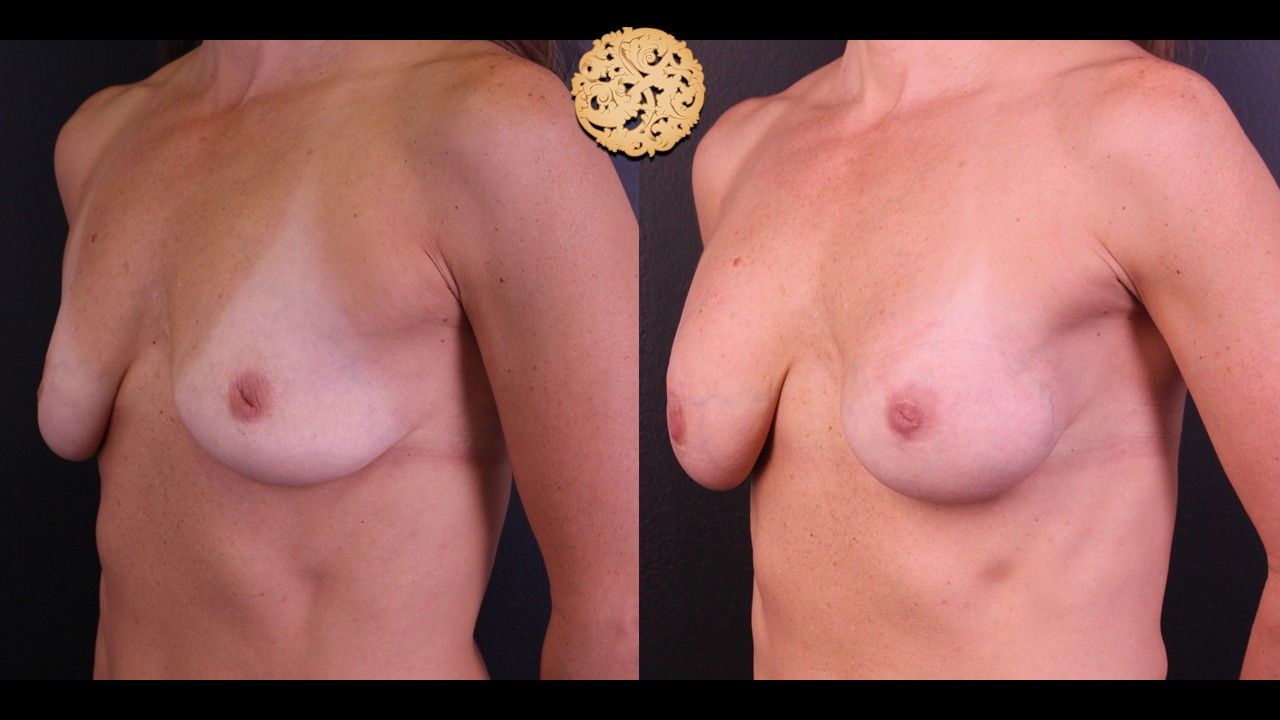 Inverted Nipple Repair Before & After
