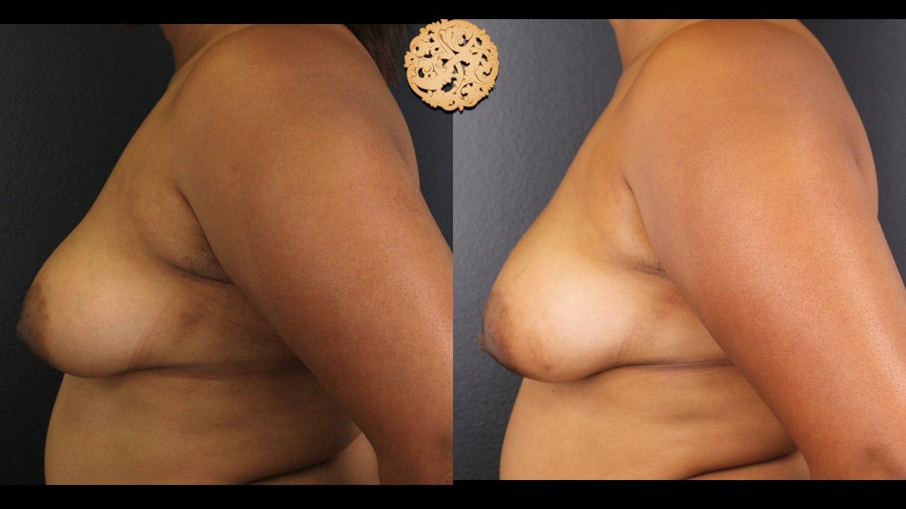 Inverted Nipple Repair Before & After