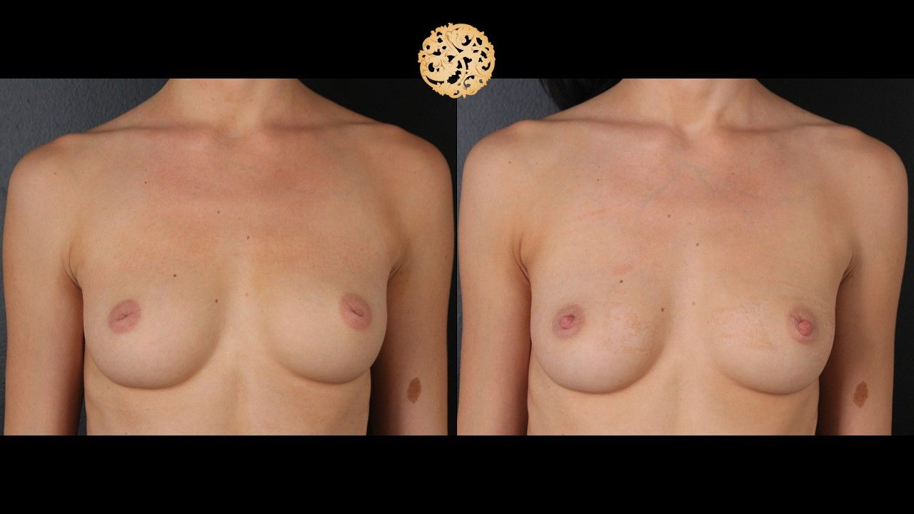Inverted Nipple Repair Before & After