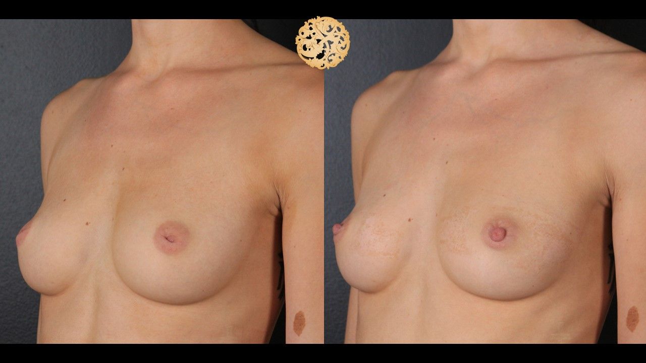 Inverted Nipple Repair Before & After