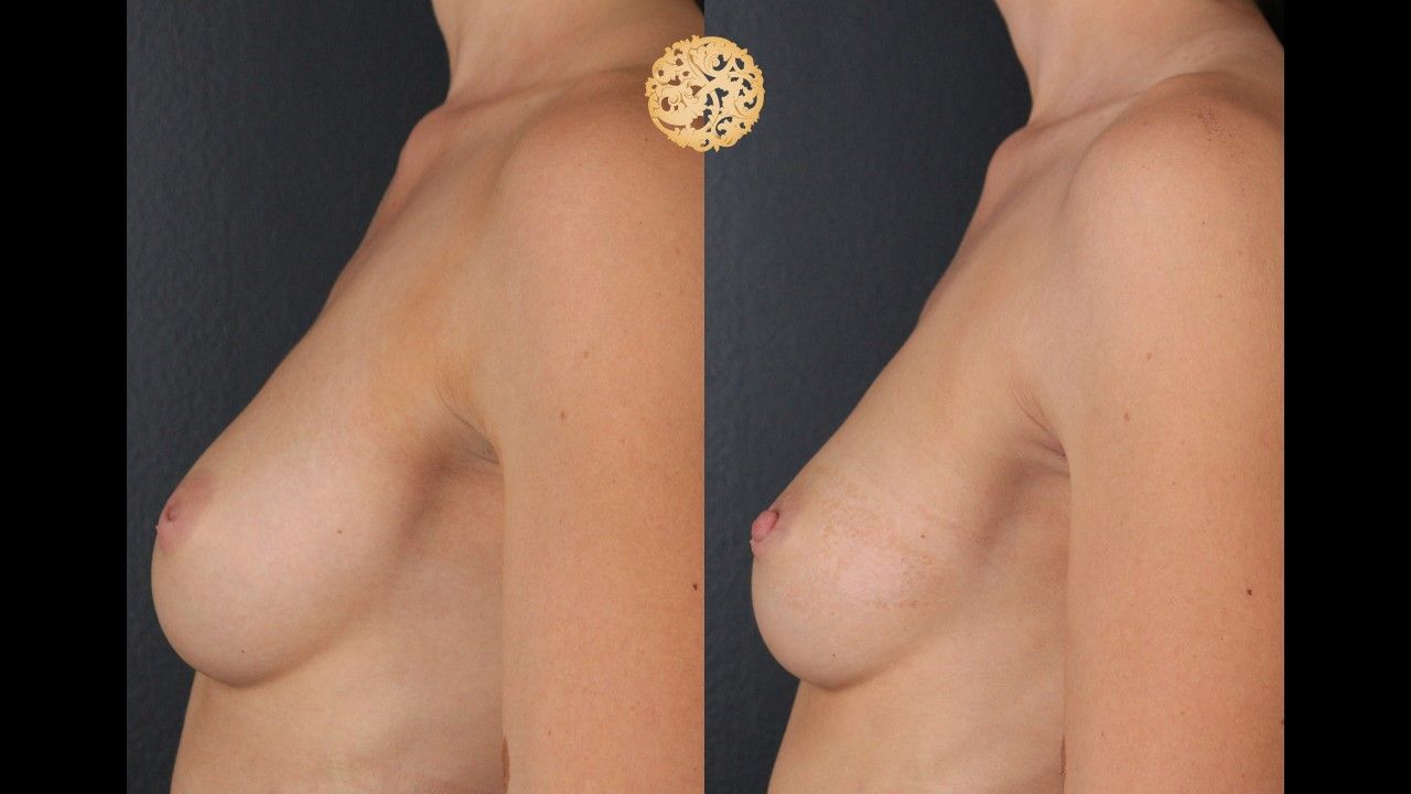 Inverted Nipple Repair Before & After