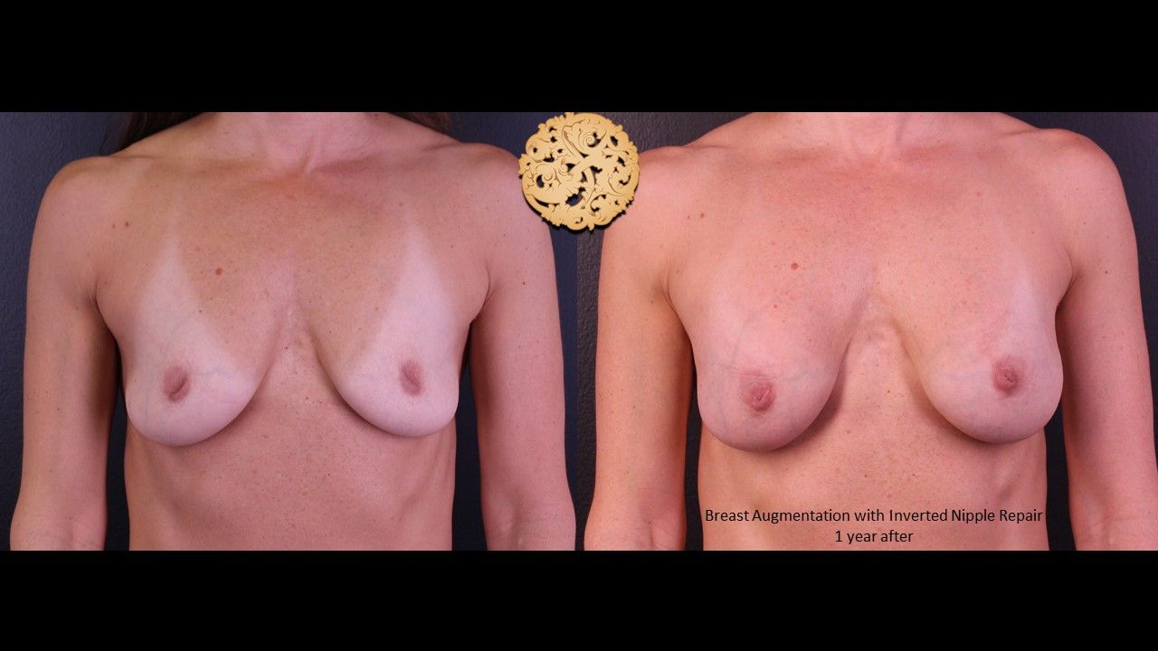 Inverted Nipple Repair Before & After