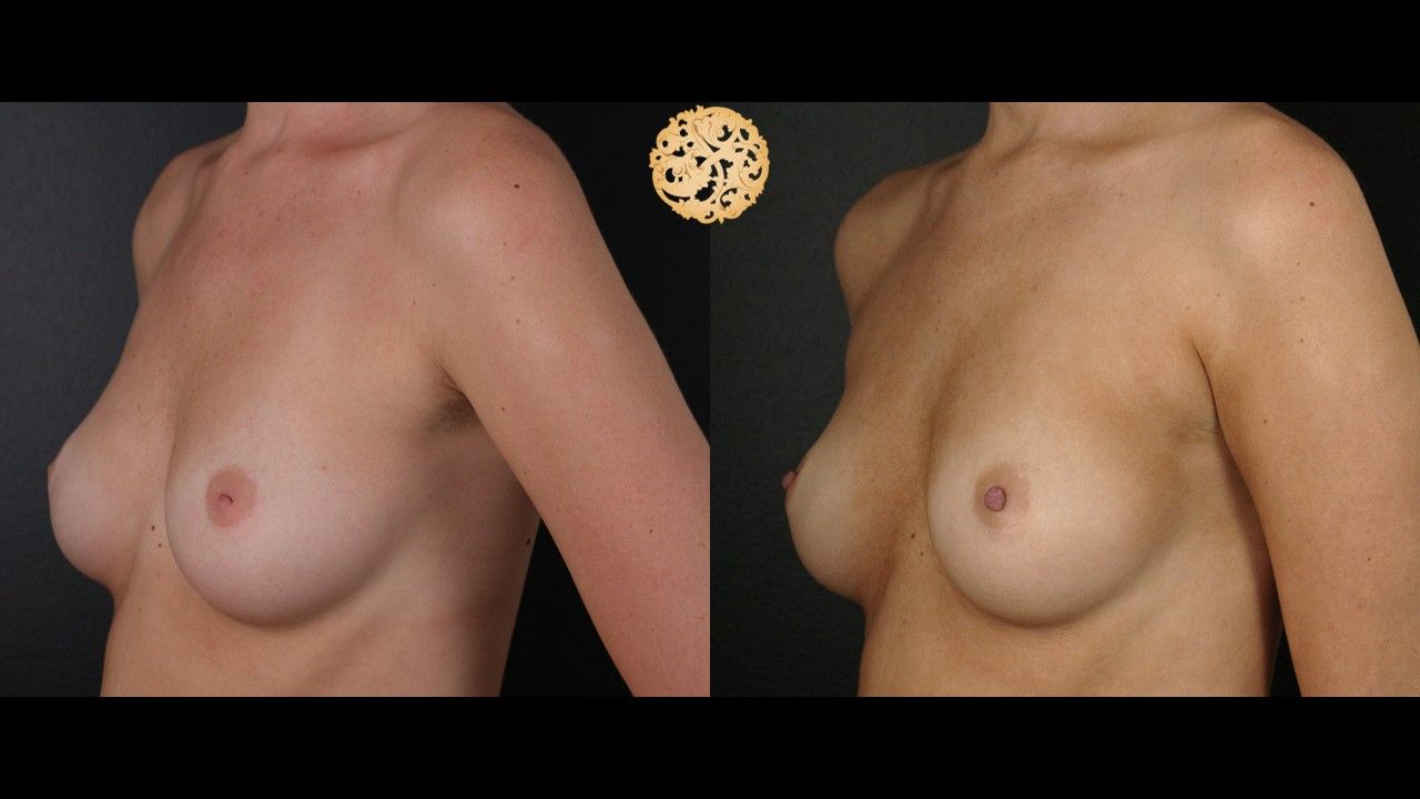 Inverted Nipple Repair Before & After