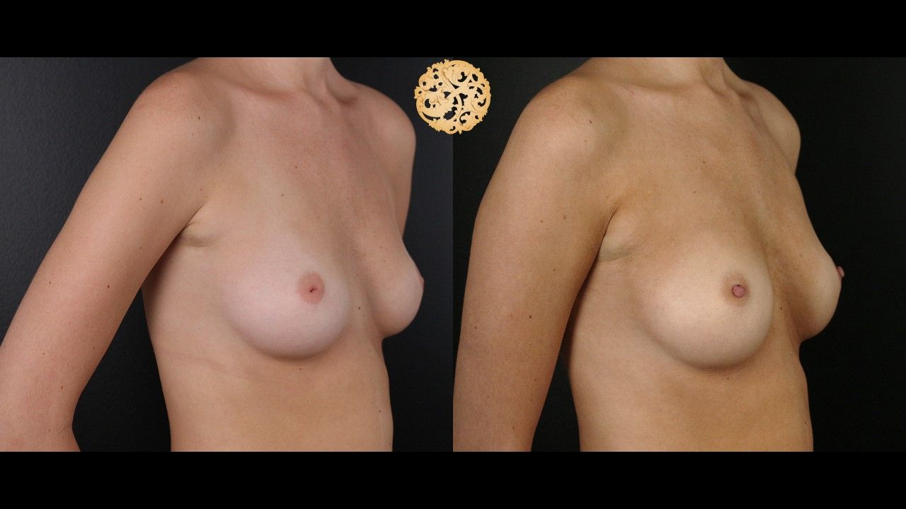 Inverted Nipple Repair Before & After