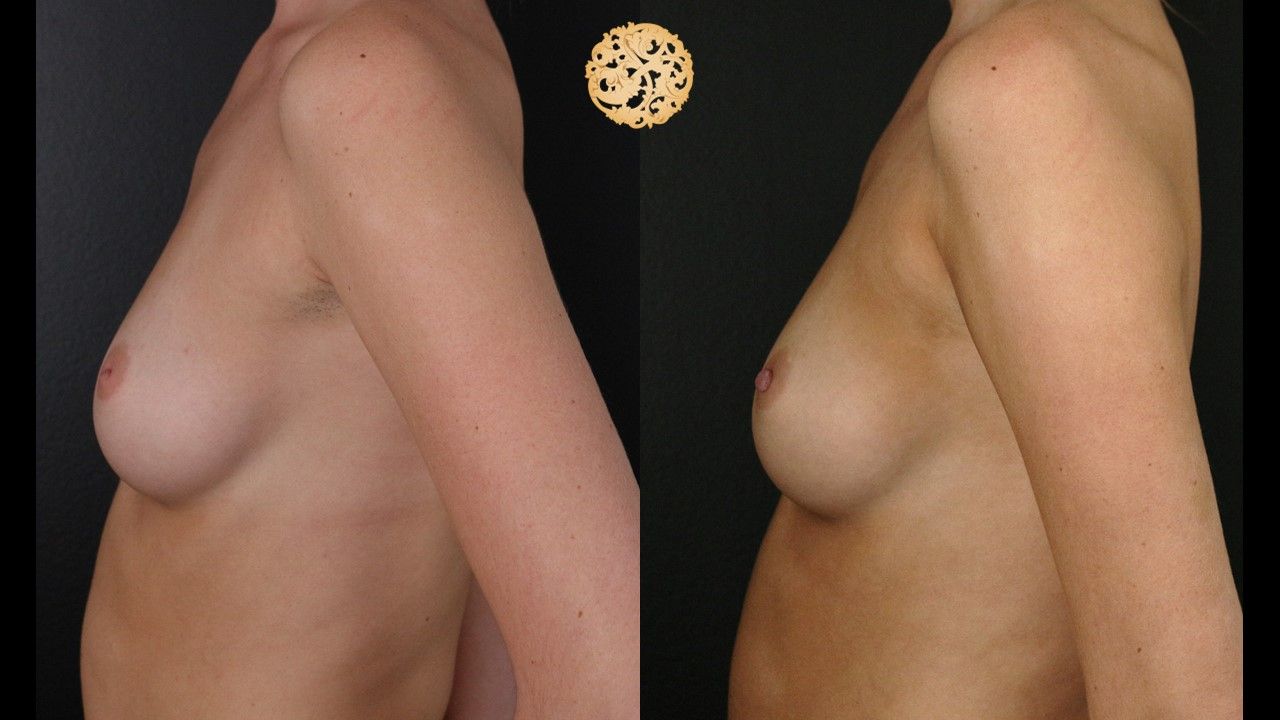 Inverted Nipple Repair Before & After