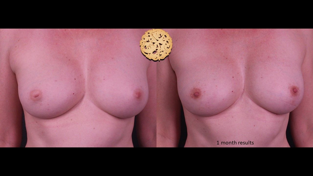 Inverted Nipple Repair Before & After