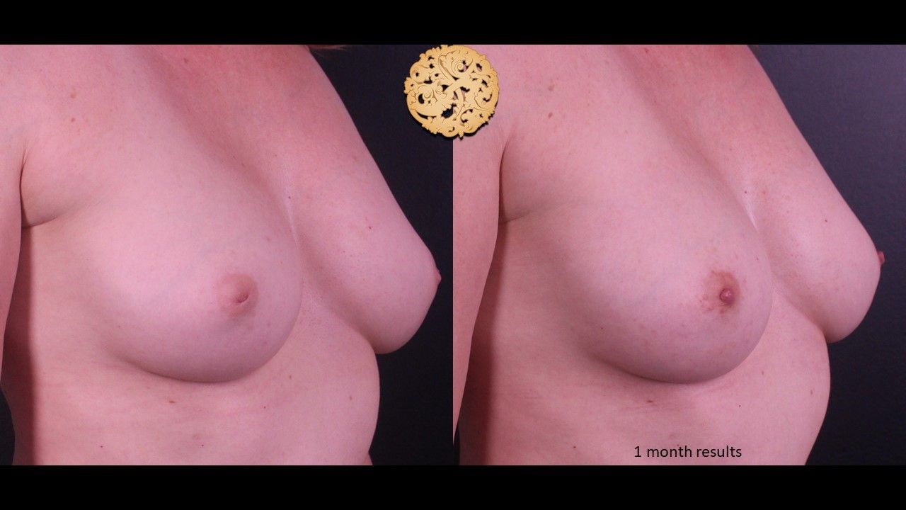 Inverted Nipple Repair Before & After