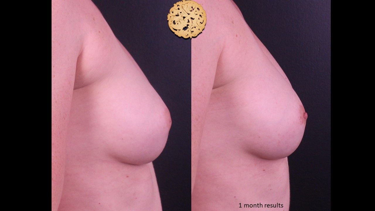 Inverted Nipple Repair Before & After