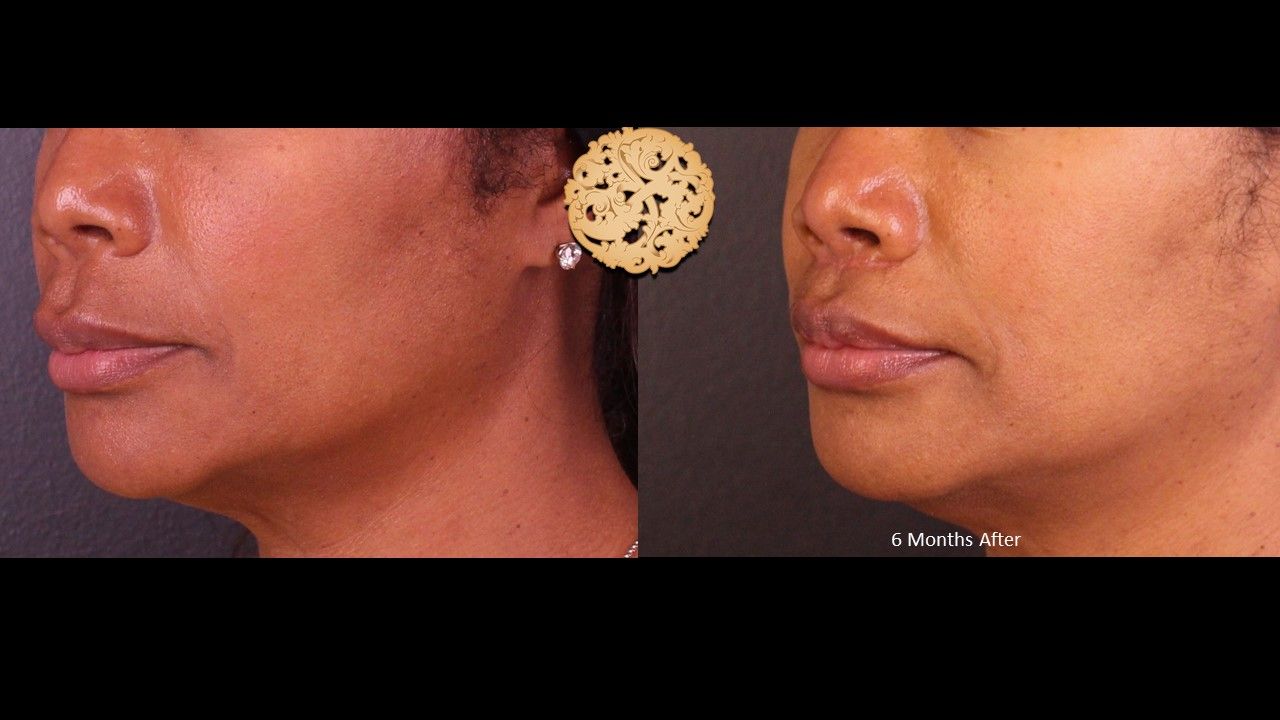 Lip Lift Before & After