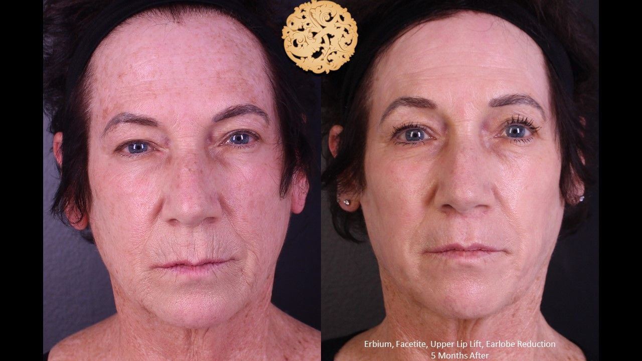 Lip Lift Before & After