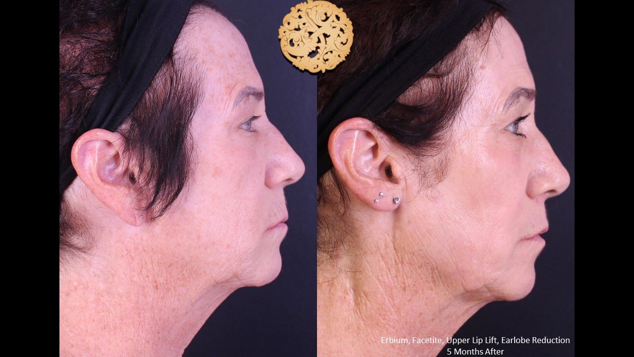 Lip Lift Before & After