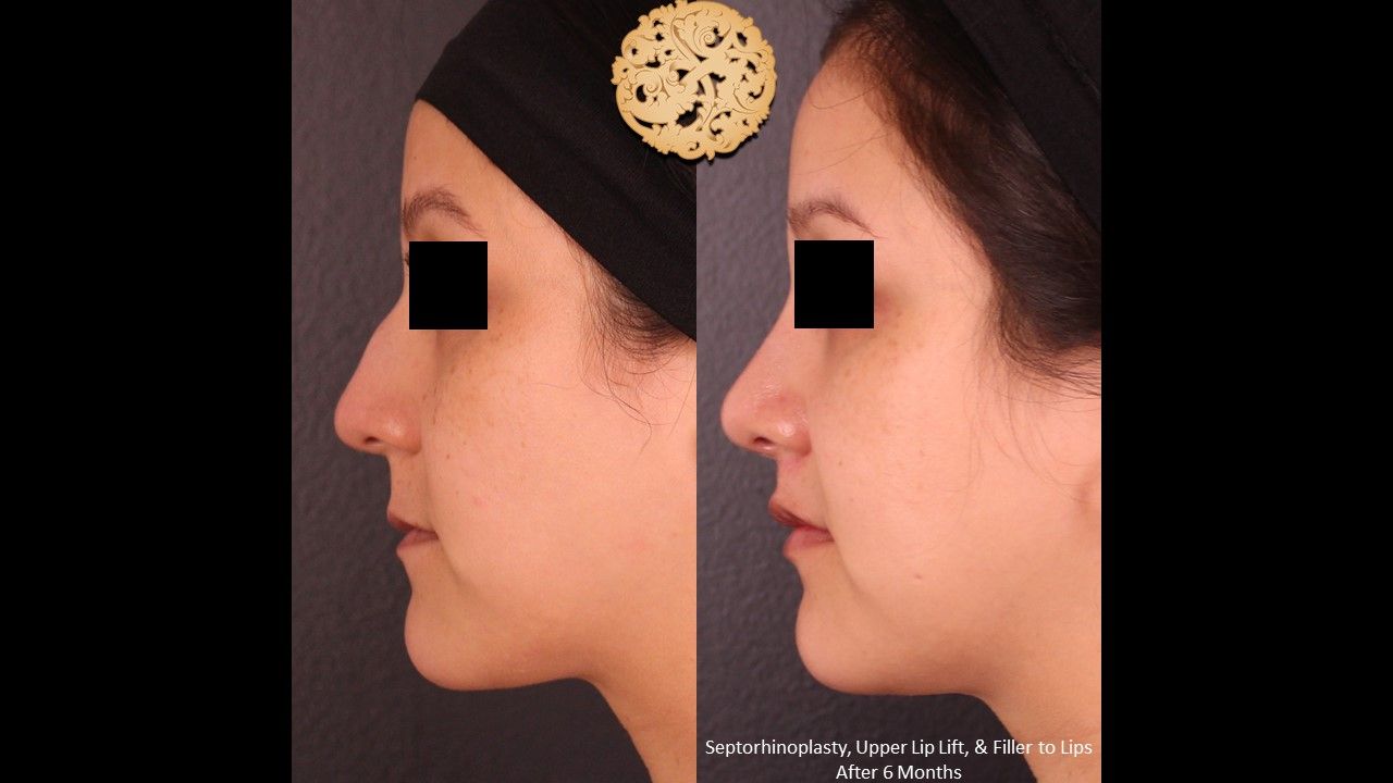 Lip Lift Before & After