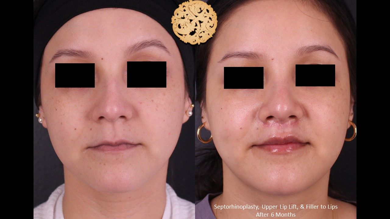 Lip Lift Before & After