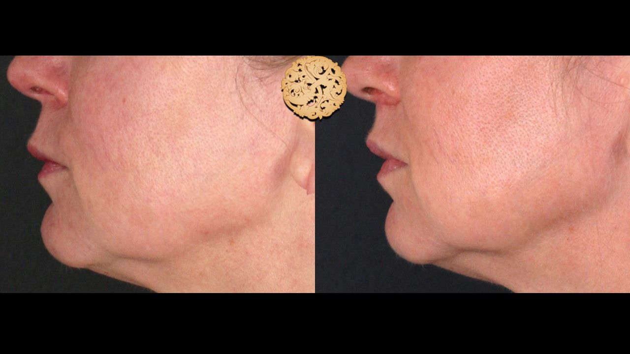 Lip Lift Before & After