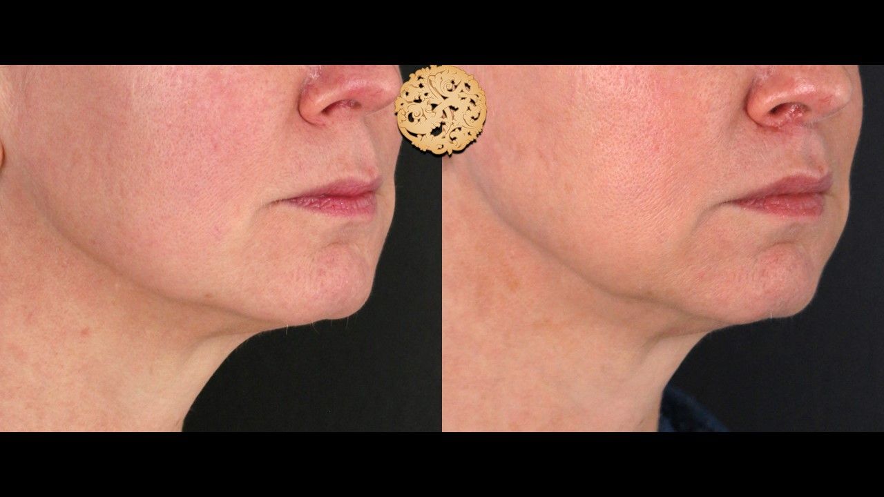 Lip Lift Before & After