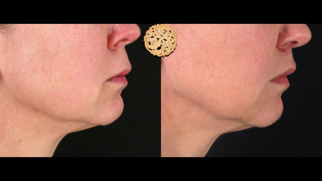 Lip Lift Before & After