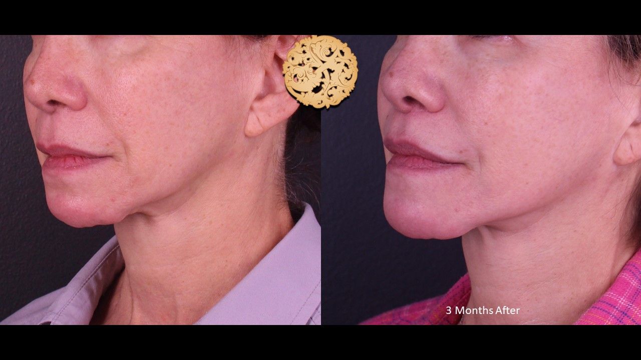 Lip Lift Before & After