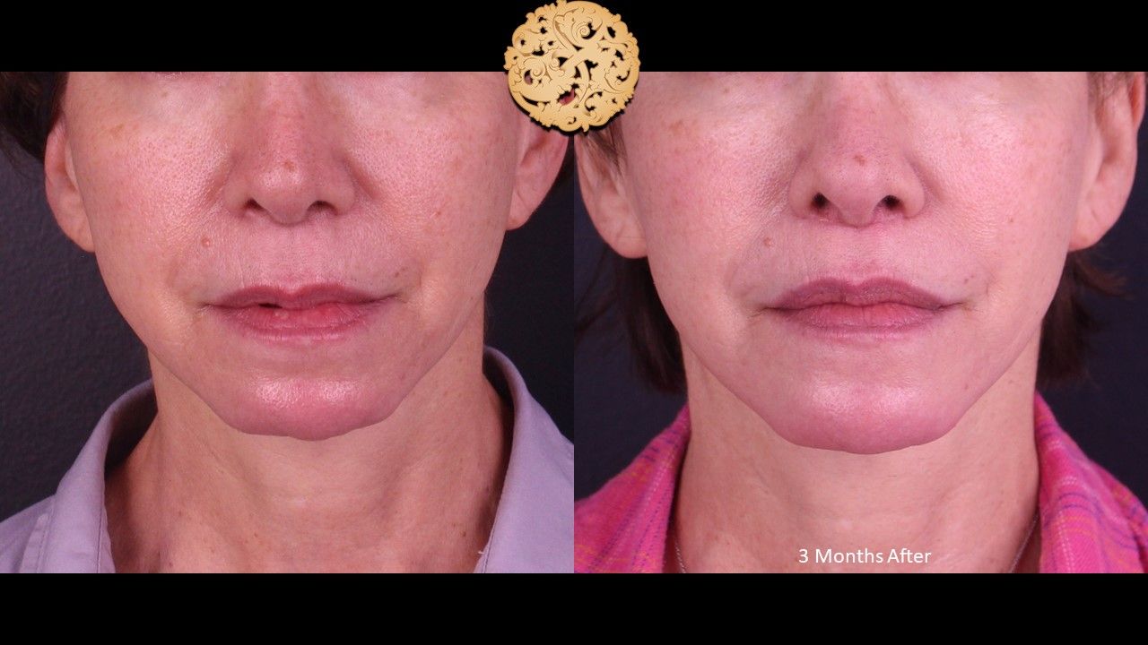 Lip Lift Before & After