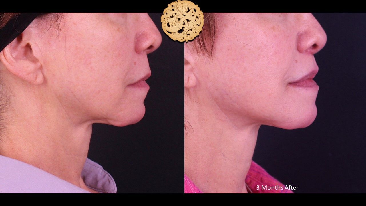 Lip Lift Before & After