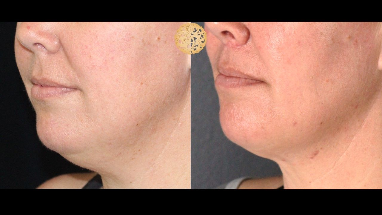 Lip Lift Before & After