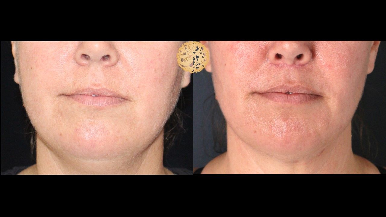 Lip Lift Before & After