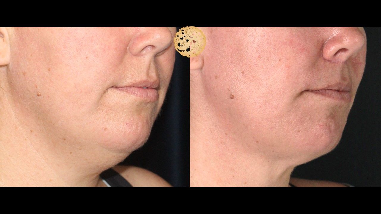 Lip Lift Before & After