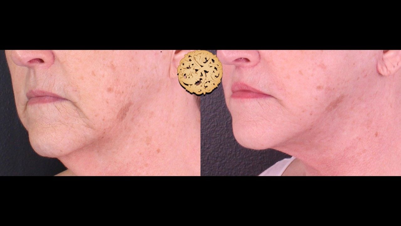 Lip Lift Before & After