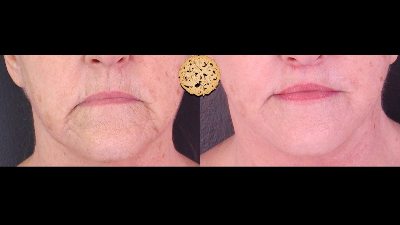 Lip Lift Before & After