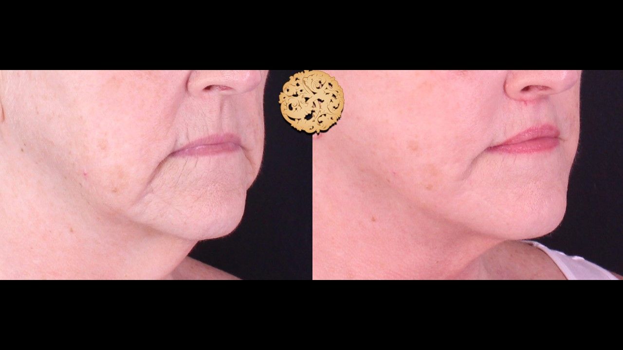 Lip Lift Before & After