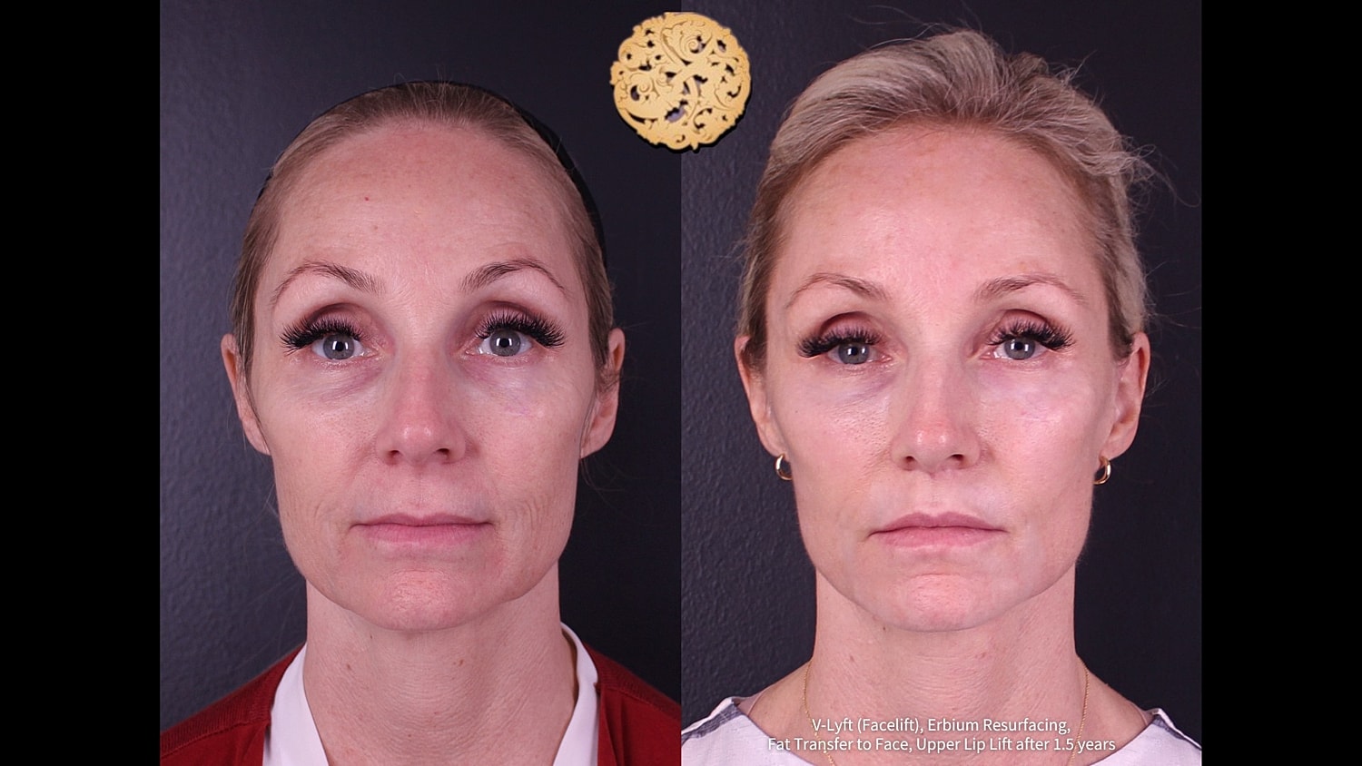Before and after facial rejuvenation treatment.