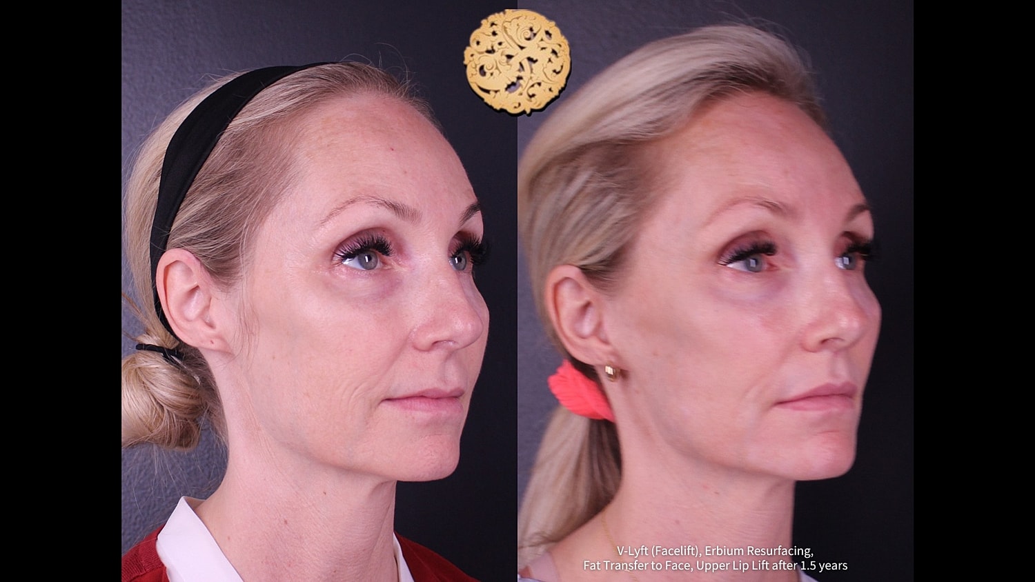 Before and after facial rejuvenation treatments.