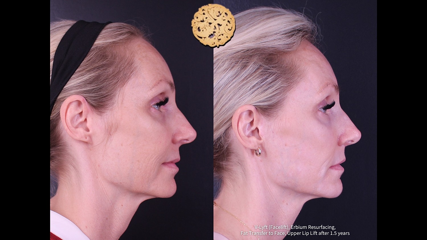 Before and after facial rejuvenation results.