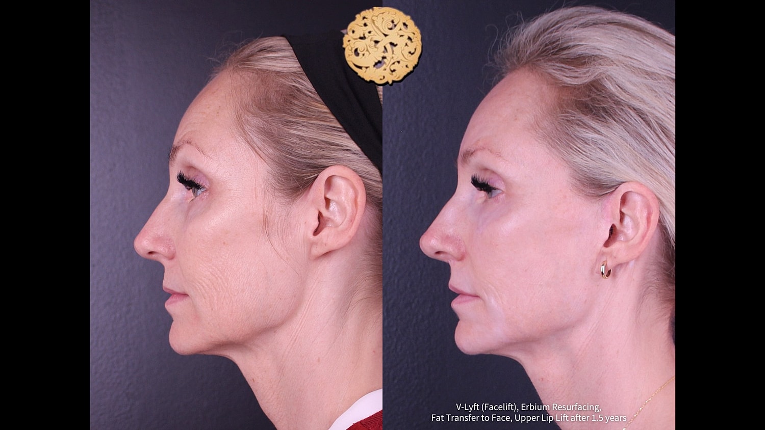 Before and after facial rejuvenation treatment comparison.