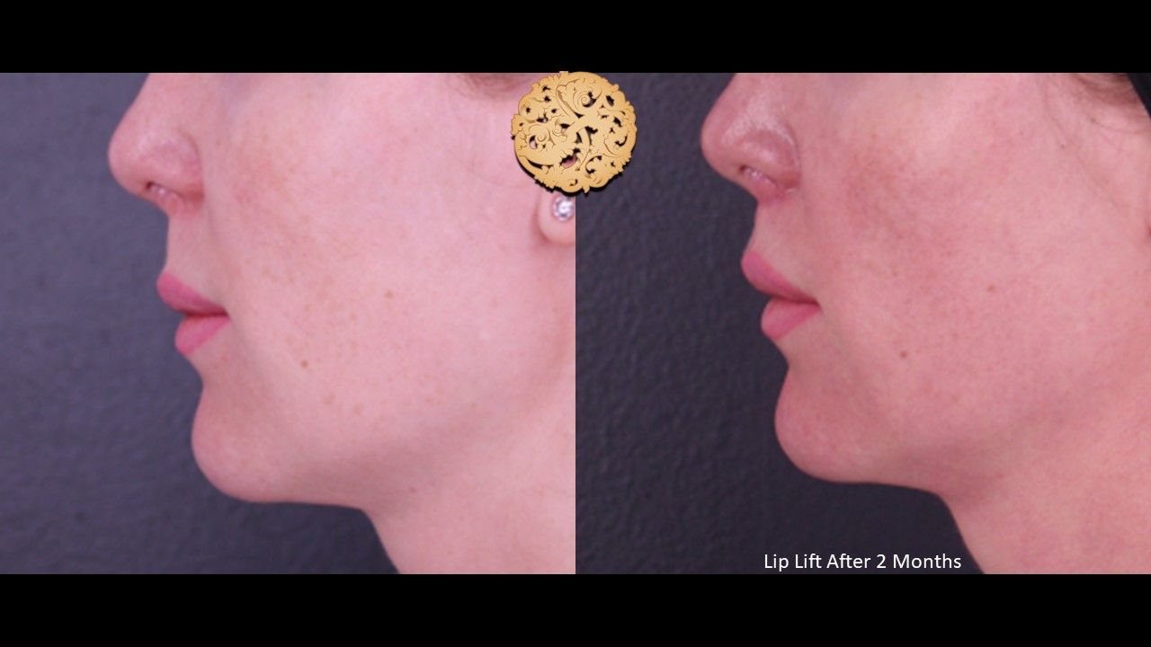 Lip Lift Before & After