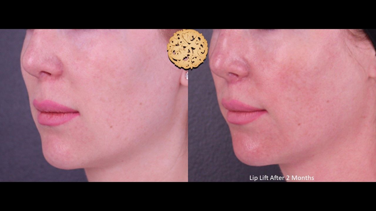 Lip Lift Before & After