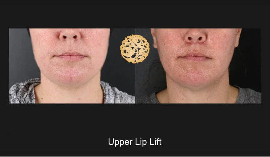 Lip Lift Before & After